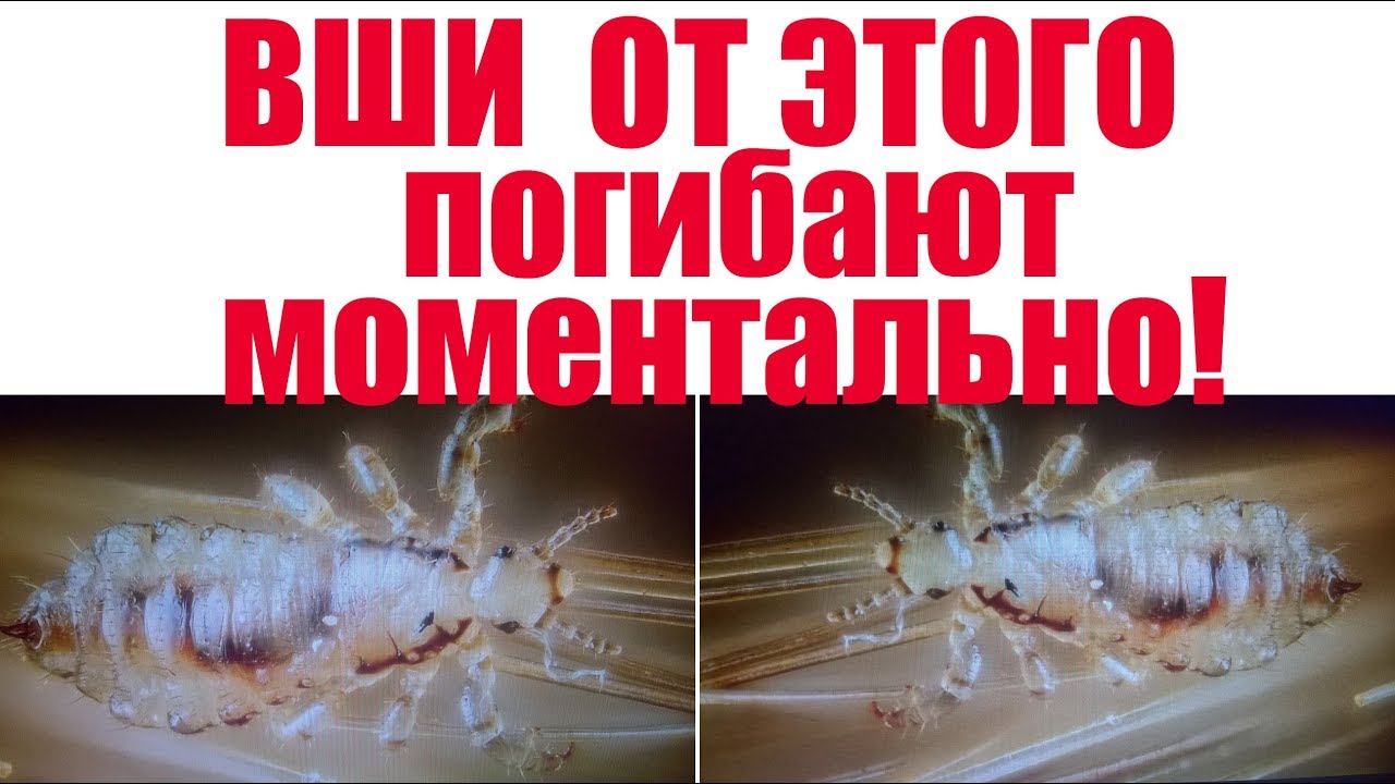 Как за 1 день избавиться от вшей и гнид в домашних условиях смотреть онлайн