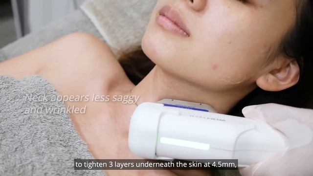 HIFU Singapore - Melts Facial Fats, Eliminate Double Chin & V shape face lifting - Bio Aesthetic смотреть онлайн