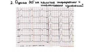 3 простых шага в анализе ЭКГ. Понятный алгоритм анализа ЭКГ.