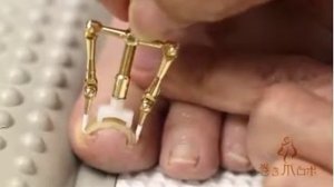 Корректор для выпрямления вросшего ногтя