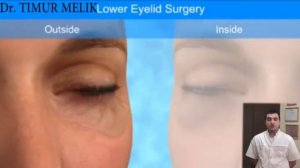 Нижняя Блефаропластика