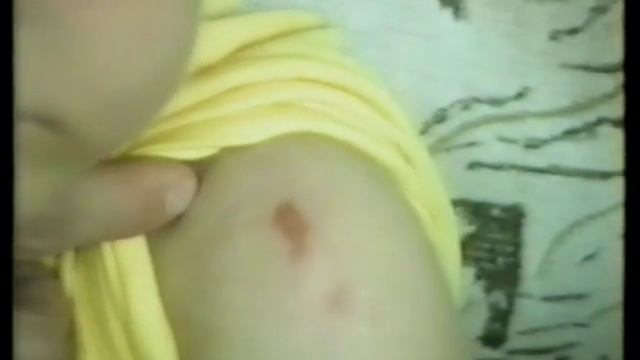 № 73 а Исчезают рубцы после ожога смотреть онлайн