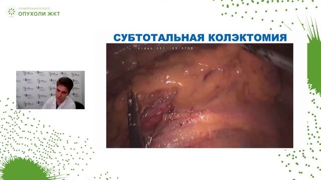 Малоинвазивная хирургия при раке ободочной кишки – от анатомии до технических приемов смотреть онлайн