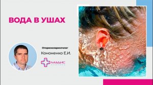 115.19. Вода в ухе, что делать?  Как убрать воду из уха? Кононенко Евгений Игоревич, ЛОР