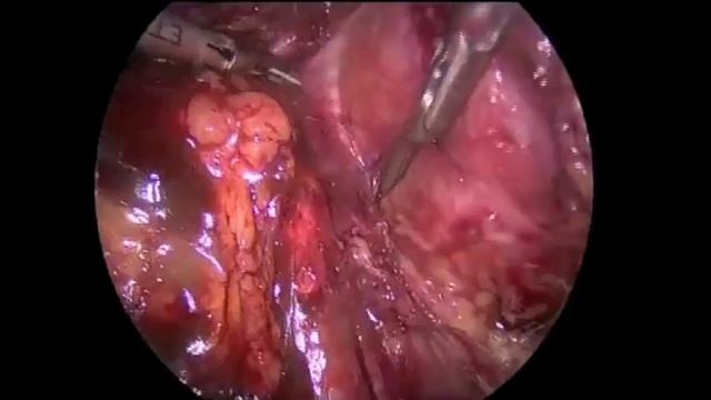 10 cm Left Pelvic Lymph Node Resection смотреть онлайн