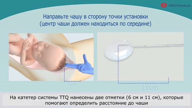 Использование TTQ