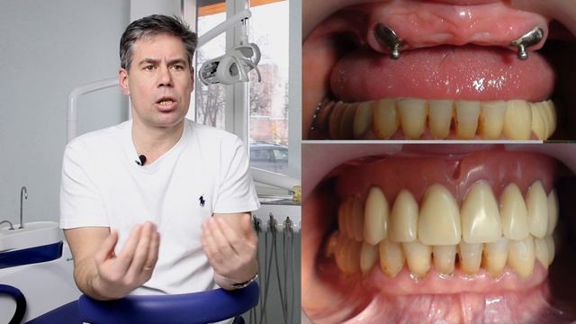 Лучший съемный протез. Что это такое? смотреть онлайн