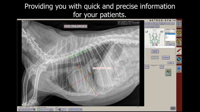 Metron with Intellect Vertebral Heart Score смотреть онлайн