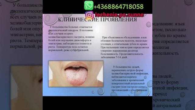 Отзыв пациентки лечившейся от ХЕЛИКОБАКТЕР пилори. смотреть онлайн