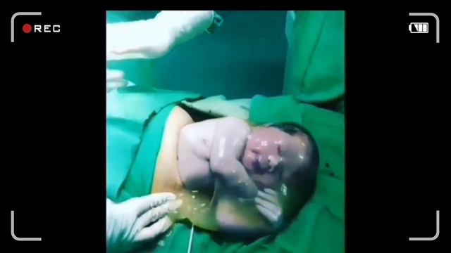 Cesarean Delivery / C-section : Surgical Technique - HD Video