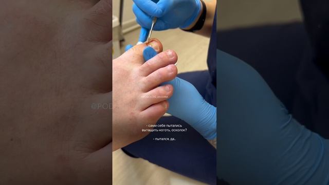 Врастание ногтевой пластины #подология #лечениеног #медицина #санктпетербург смотреть онлайн