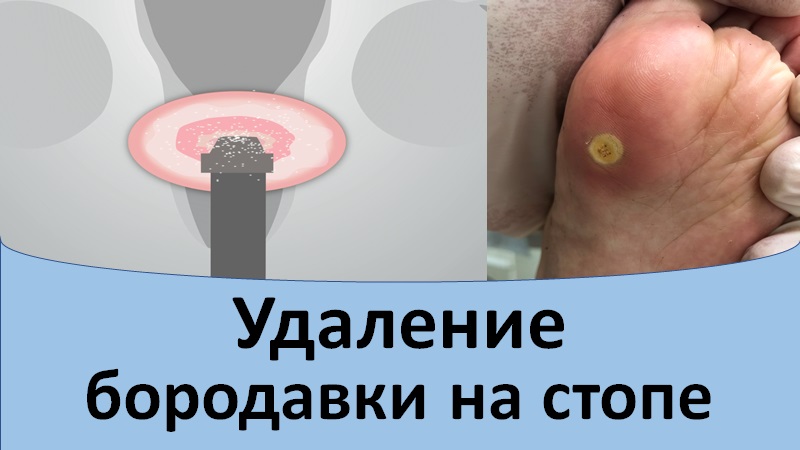 Удаление бородавки на стопе смотреть онлайн