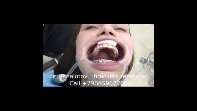 Удаление брекет системы смотреть онлайн