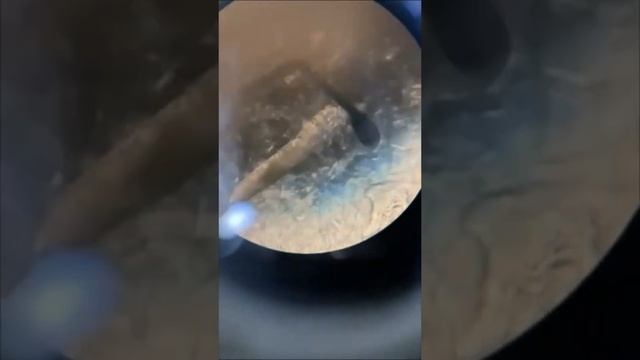 Демодекс (Demodex folliculorum) - 400X смотреть онлайн