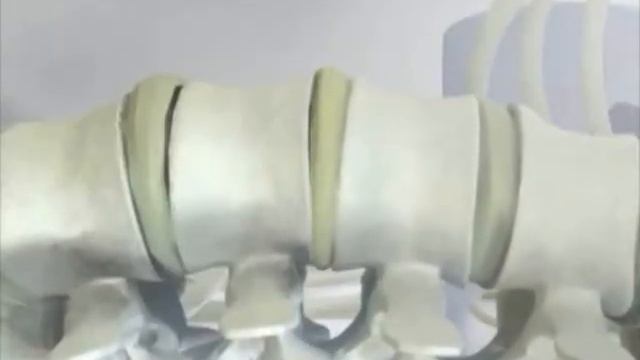 DRX 3D. Лечение протрузий, межпозвонковой грыжи на аппарате DRX смотреть онлайн