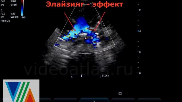 Стеноз ветвей ЛА смотреть онлайн