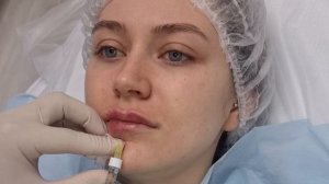 увеличение губ "Парижская" (классическая) техника