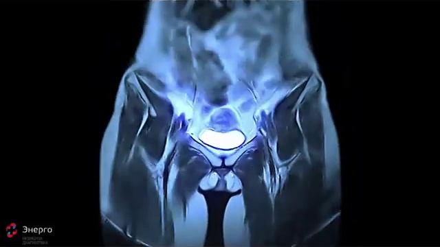 Компьютерная томография органов малого таза смотреть онлайн