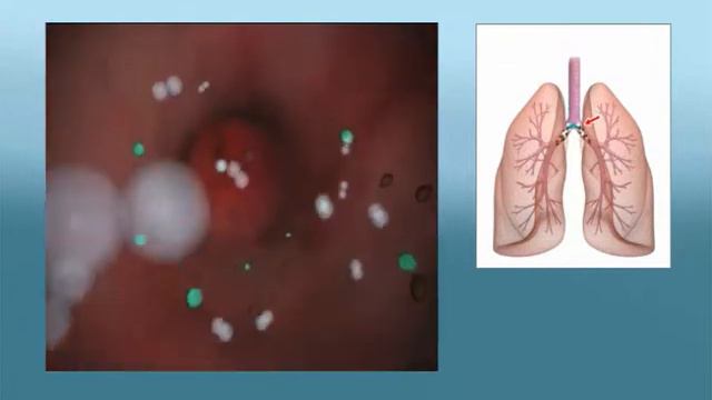 COPD (KOAH) ve Turbuhaler? смотреть онлайн