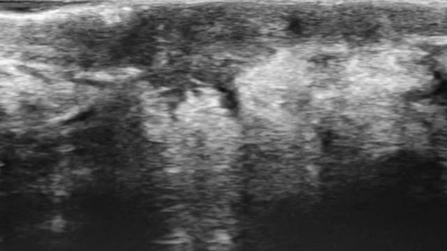 TMT: BIRADS V Lesions by Dr Shanti Shetty смотреть онлайн