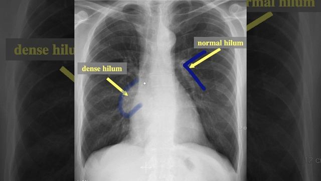the dense hilum sign смотреть онлайн