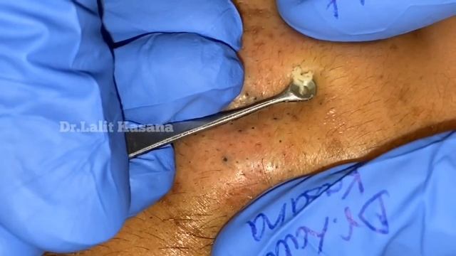 Best of Blackheads Removal by Dr Lalit Kasana / Repost смотреть онлайн