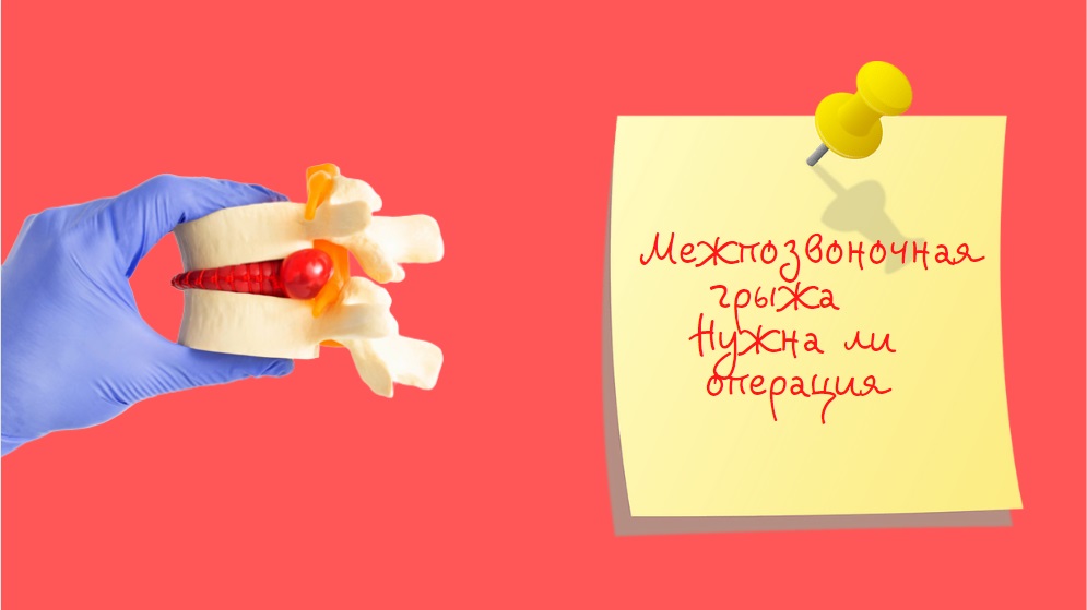 Межпозвоночная грыжа | Нужна ли операция