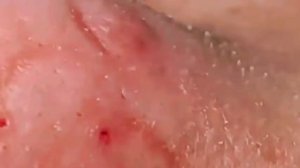 ✅ Выдавливание прыщей #12