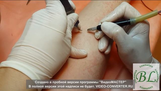 Электроэпиляция -удаление волос навсегда! смотреть онлайн