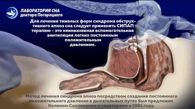 Что такое СИПАП-терапия (CPAP)? смотреть онлайн