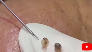 No. 23 Squeezing neglected pimples. Давим прыщи и угри запущеннее 우리는 여드름과 블랙 헤드를 더 소홀히 부숴 버립니다.