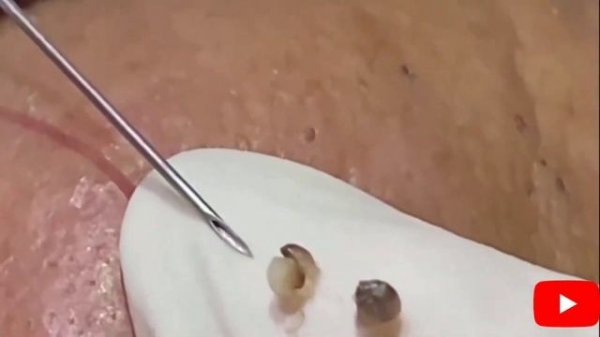 No. 23 Squeezing neglected pimples. Давим прыщи и угри запущеннее 우리는 여드름과 블랙 헤드를 더 소홀히 부숴 버립니다.