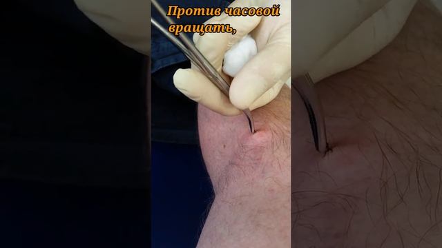 Как удалить клеща. смотреть онлайн