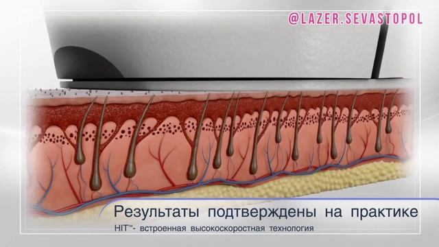 Лазерная Эпиляция в Севастополе Lumenis LightSheer DESIRE смотреть онлайн