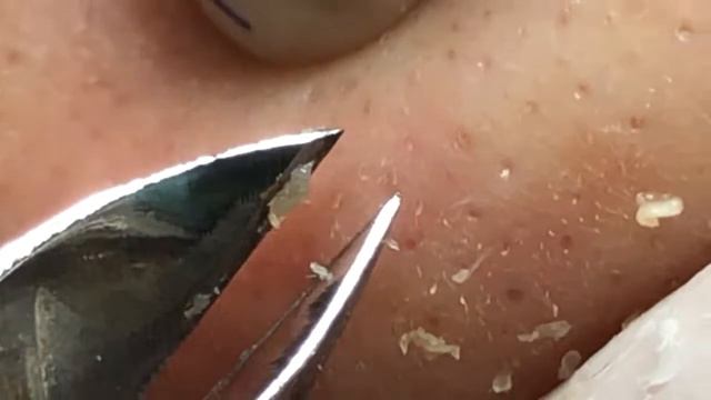角栓 ブラックヘッド 角栓除去 ニキビ芯出し | ーニキビ #にきび治療    #BlackHeads #Whiteheads  #Acnes    #Dr.Somaria