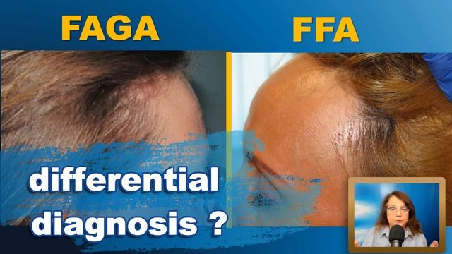 The 5 Trichoscopy Features Of Androgenetic Alopecia