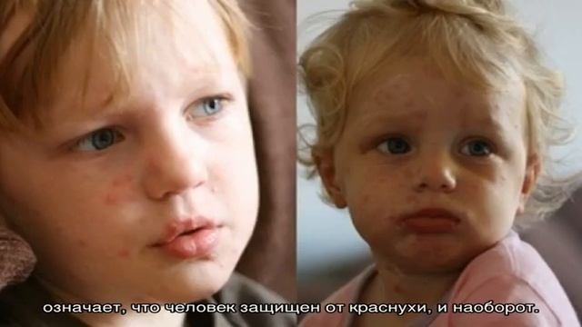 Ветрянка и краснуха – это одно и тоже или нет? смотреть онлайн