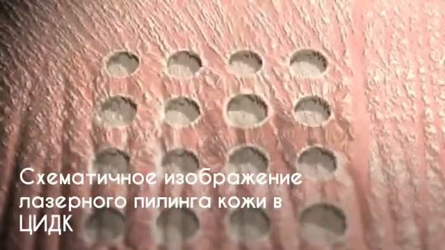 Лазерный пилинг в ЦИДК смотреть онлайн