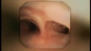 бронхоскопия