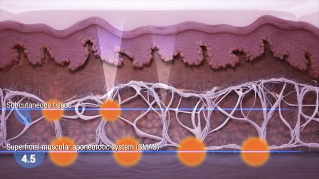 Tratamiento hifu ¿Cómo funciona? смотреть онлайн