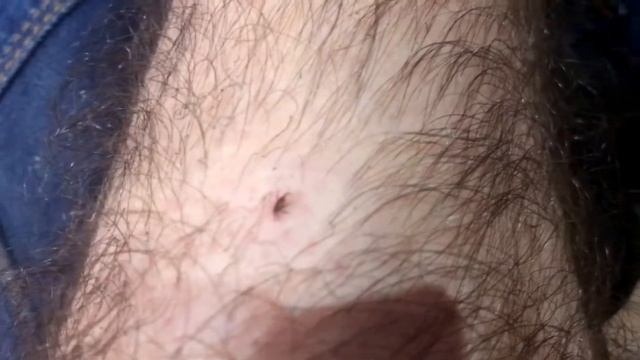 Как вытащить клеща обычной нитью смотреть онлайн