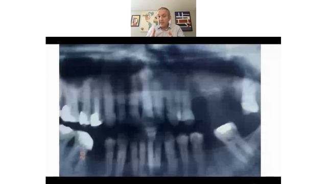 ?? Prof. Dr. Hakan Özyuvaci - Oral implantolojide Maksiller sinüslerin önemi | Online Congress смотреть онлайн