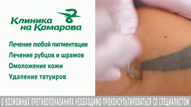 ПИКОСЕКУНДНЫЙ ЛАЗЕР PicoCare смотреть онлайн