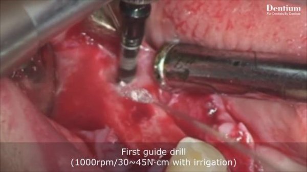 Dentium tissue level implant - SimpleLine ll -
