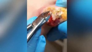 Изначально это была бородавка???