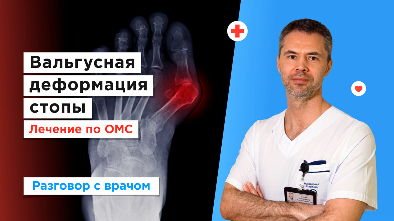 Лечение вальгусной деформации стопы по ОМС смотреть онлайн