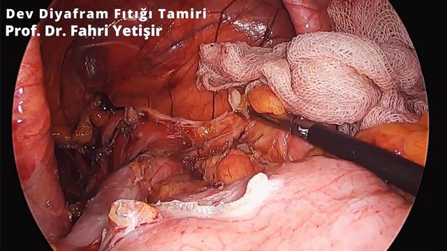 Dev diyafram fıtığı ve kısa özefagus ameliyatı смотреть онлайн