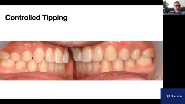 David Raikovic: Биомеханика элайнеров смотреть онлайн