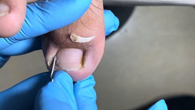 Treatment Of Inflamed Ingrown Nails 【Foot Scalpel】