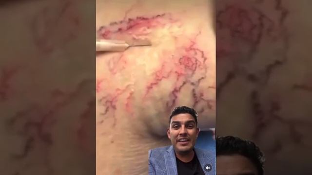 ESCLEROTERAPIA #tendencia #shorts